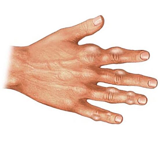 Kusihappekristallide ladestumine podagra artriidiga sõrmede pehmetesse kudedesse