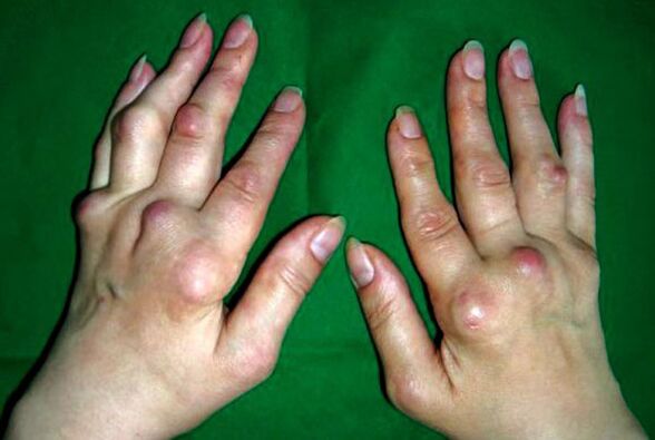 Käed, mida mõjutab deformeeriv polüosteoartriit